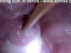 Insertion Semen Jizz in Cervix Wide Stretching Slit Speculum